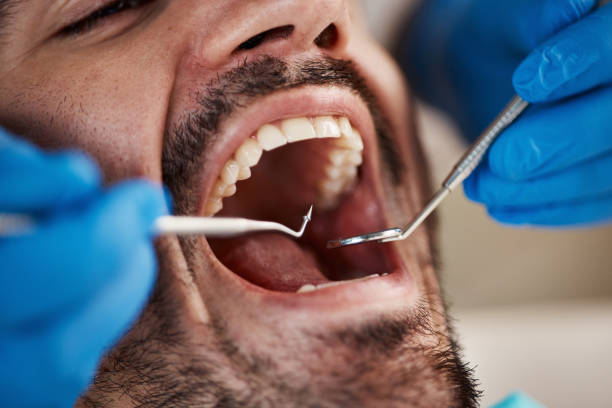 Best Emergency Wisdom Teeth Removal in Damascus, MD