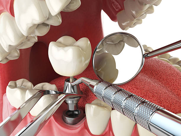 Best Emergency Tooth Extraction in Damascus, MD